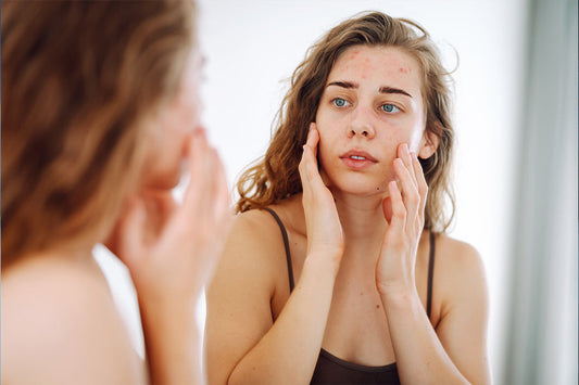Stop Acne in Its Tracks: Top Skincare Tips to Avoid Recurring Breakouts